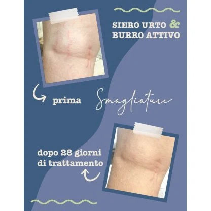 Siero Urto Smagliature - La Saponaria